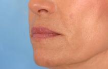 Hyaluronic Acid After